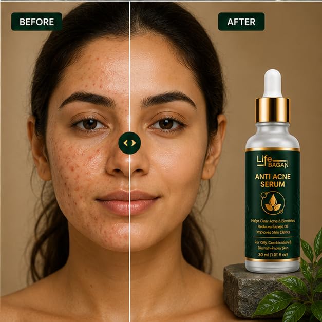 Life Bagan Anti Acne Face Serum | Lightweight Daily Facial Serum for Clearer-Looking & Balanced Skin | Fast Absorbing Non-Greasy Formula | Suitable for Oily & Combination Skin | 30ml
